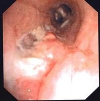 Bronchoplasty (autologous pericardium): left mainstem bronchus