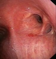 Sleeve resection of the Middle lobe and the RUL