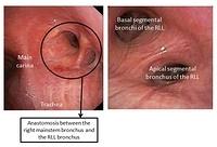 Sleeve resection of the Middle lobe and the RUL - annotations