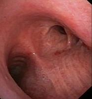 Sleeve resection of the Middle lobe and the RUL