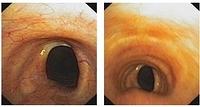 Tracheal stenosis after tracheostomy