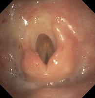Supraglottic partial laryngectomy