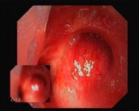 Tracheobronchial gland (salivary gland) tumours