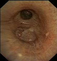 Squamous cell (epidermoid) carcinoma