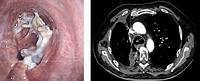 Actinomyces infection