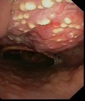 Oral candidiasis (Thrush)