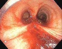 Laceration/rupture of the membranous tracheal wall after surgical tracheostomy